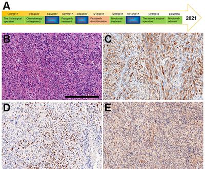 Case Report: A PD-L1-Positive Patient With Pleomorphic Rhabdomyosarcoma Achieving an Impressive Response to Immunotherapy